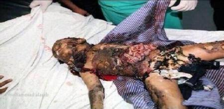 Έκαψαν ζωντανό τον Mohammad Abou Khdeir - Mohammad Abou Khdeir burnt alive - Mohammad Abou Khdeir brûlé vivant